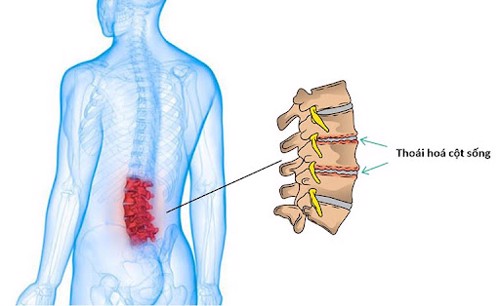 Thoái hóa cột sống thắt lưng - Dấu hiệu nhận biết và cách điều trị
